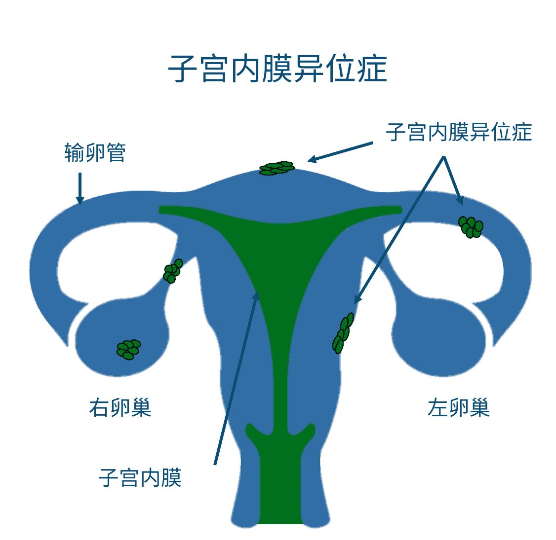 子宫内膜异位症