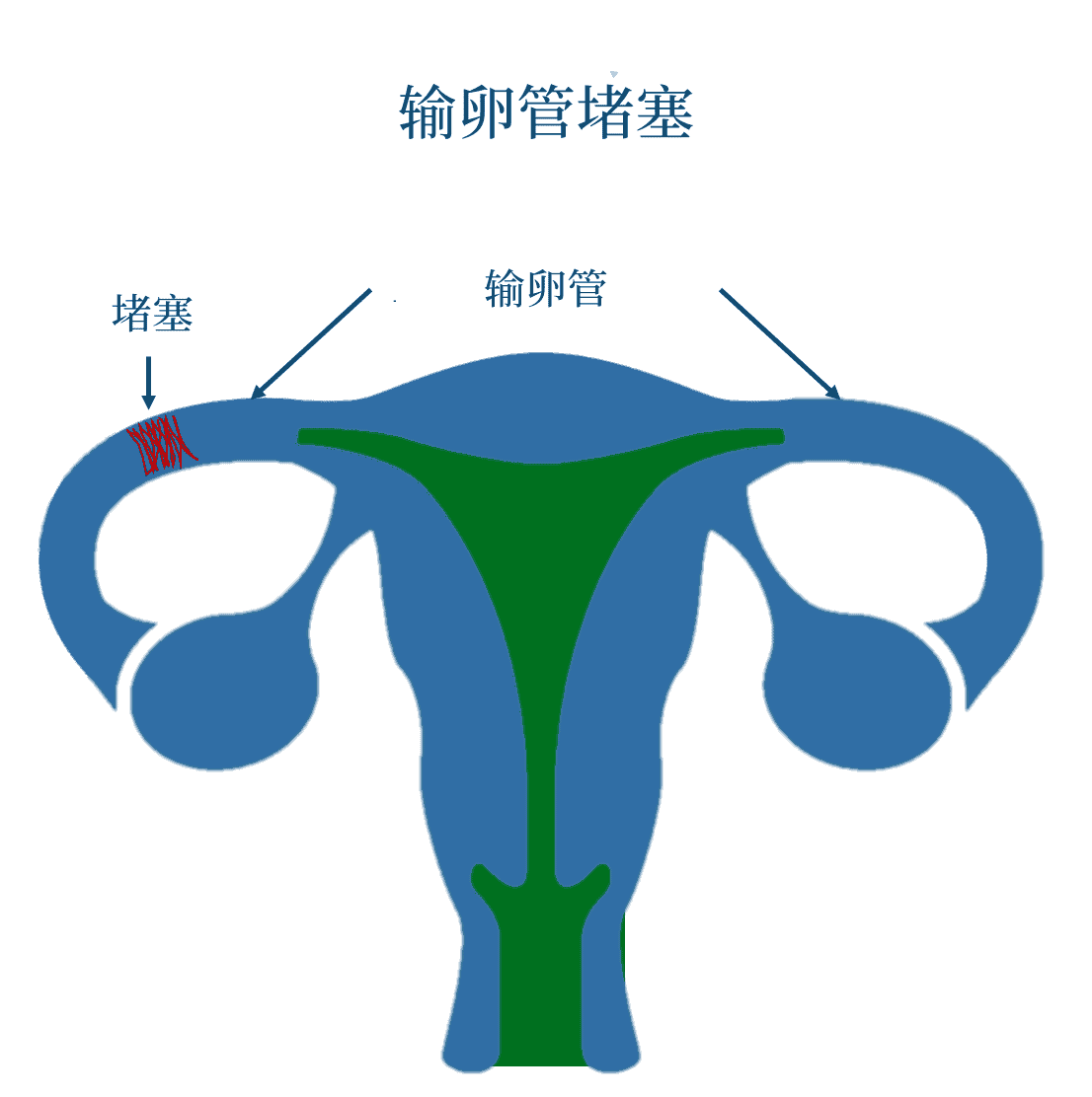 tubalblcokage(Chinese (Simplified))