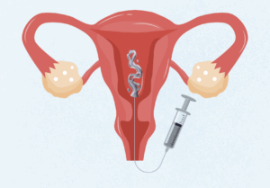 Hysterosalpingogram (HSG) - Generation Next Fertility